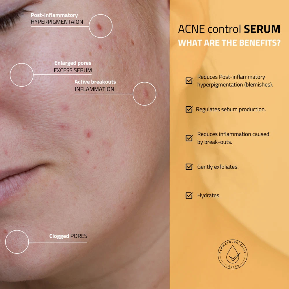Acne & Blemish Control Anti Redness Serum with Niacinamide & PAD, Skin Clearing