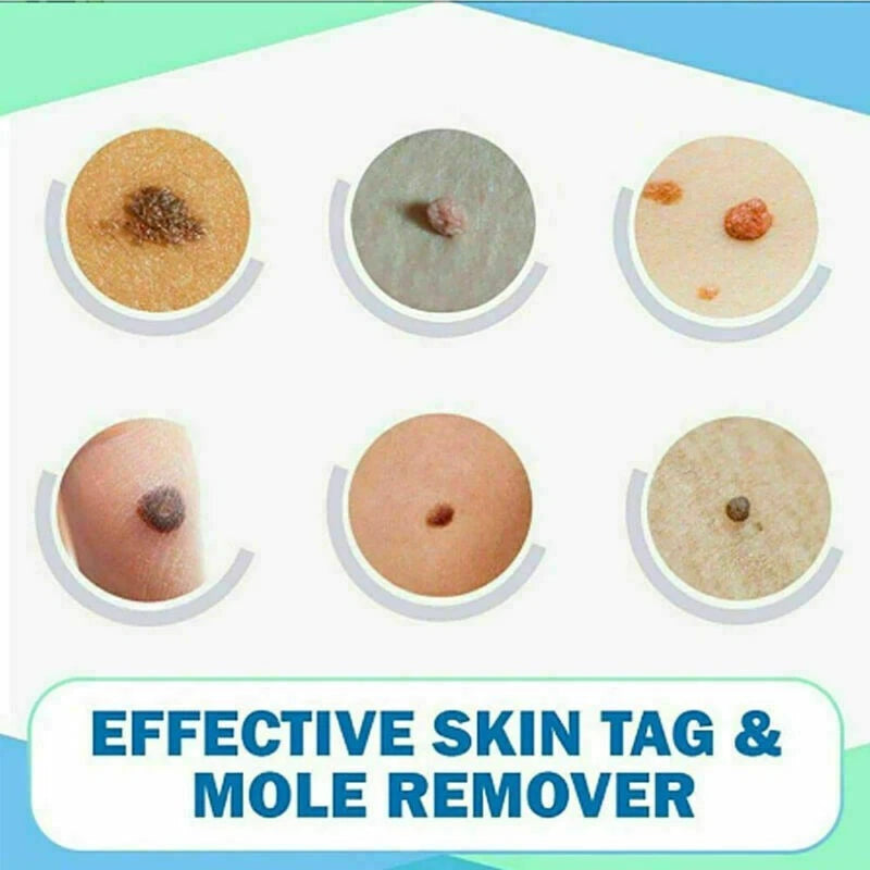 WipeOff™ Skin Tags & Moles Warts Corn Remover - Restore Skin Health and Beauty