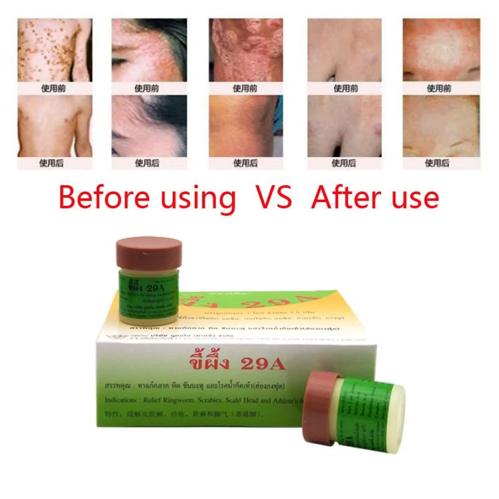 3x Effective Thailand 29A Natural Ointment Psoriasi Eczma Cream and Urticaria