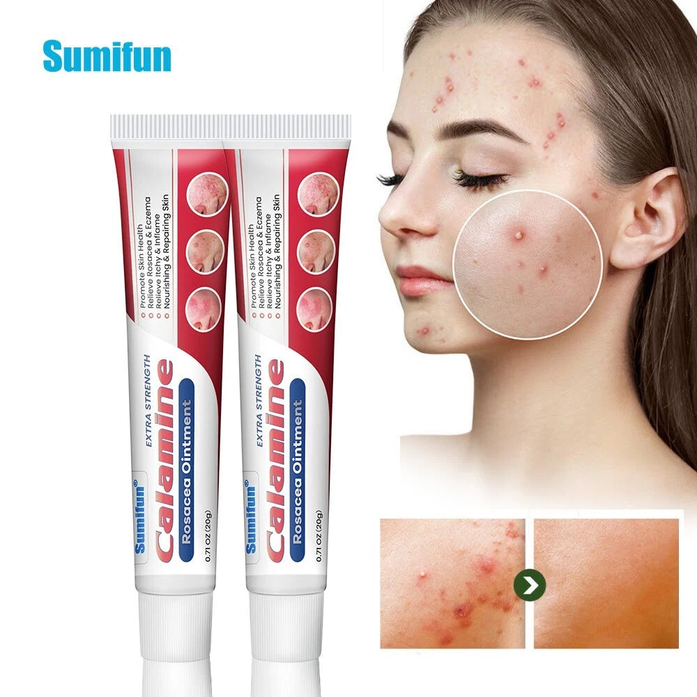 20g New Rosacea Ointment Treat Red Nose Acne Cream Pimple Scar Repair Skin Care