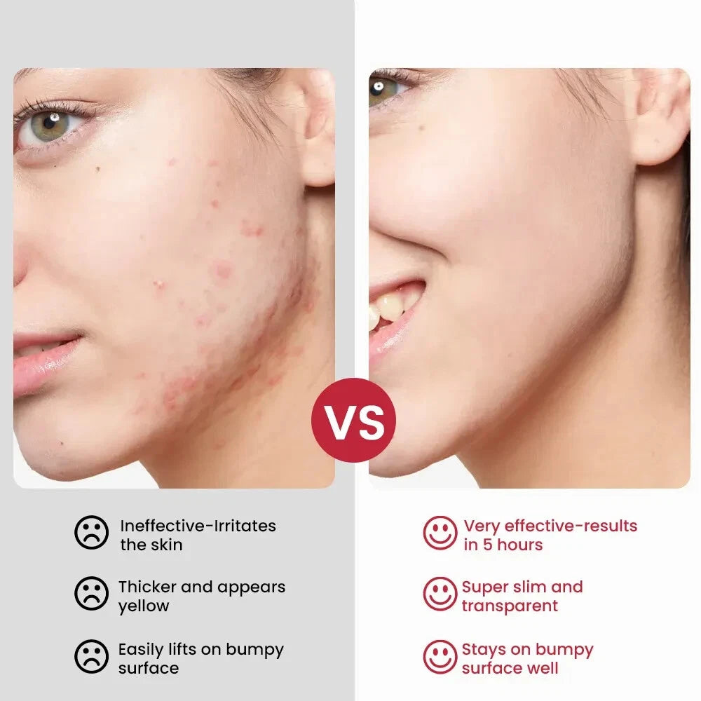 New 20g Rosacea Ointment Treat Red Nose Acne Cream Pimple Scar Repair Skin Care