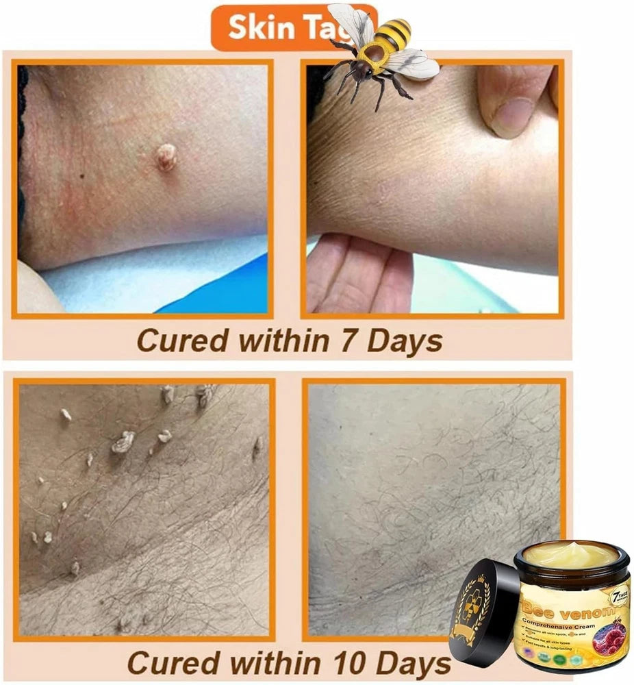2Pcs Bee Venom Cream, Bee Venom Skin Treatment Cream, Bee Venom Wrinkle Removal