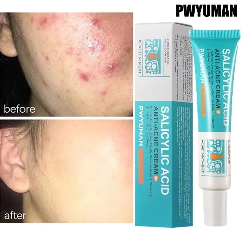 Salicylic Acid Strong Acne Removal Cream Anti Acne Pimple Scars Spots Clean Uk