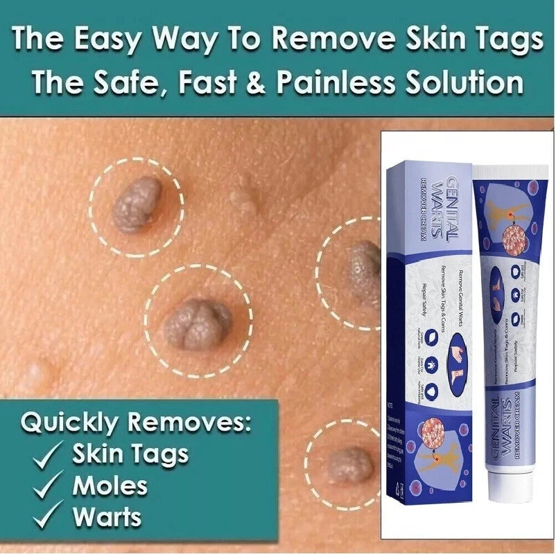 Skin Tag Mole Wart Remover Removal Cream Ointment Fast Safe Natural Treatment