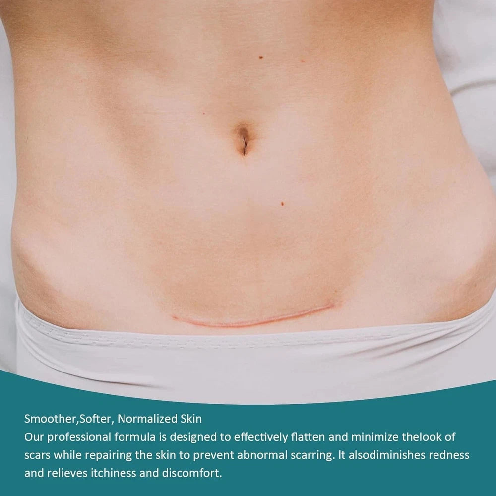 Scar Removal Cream Silicone Gel for Old & New Scars Surgery Stretch Marks