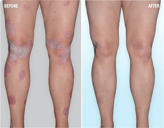 Salytar - 3% Salicylic Acid & 6% Coal Tar Ointment for Dry Skin Moisturizing 30g