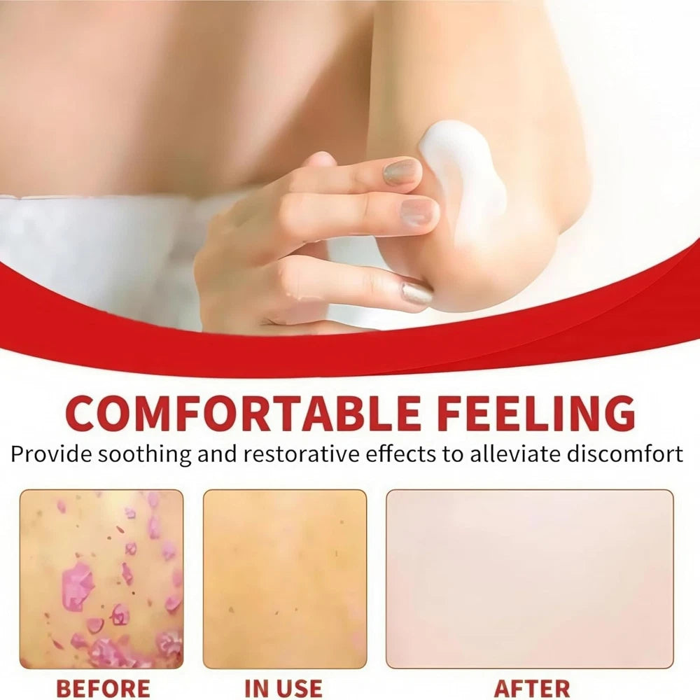 Anti Fungal Skin Cream,Skin Repairing Cream for Face Body,Fungal Cream for Skin,