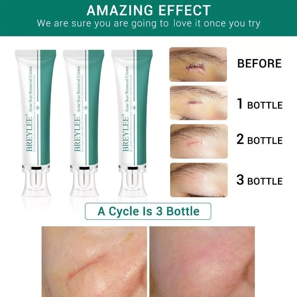 Breylee Acne Scar Removal Cream 30G Face Cream Skin Repair Skin Care Scar Acne