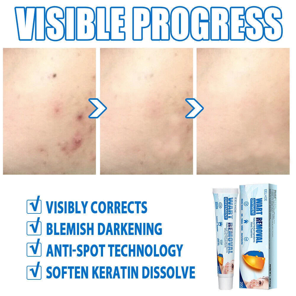 Skin Tag Removal Warts Remover Cream Herbal Ointment Face Body Tag Remover 20g