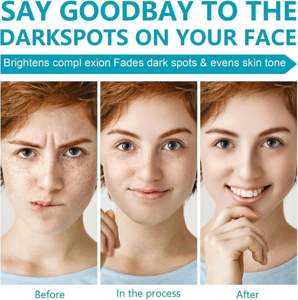 Hyperpigmentation Treatment Cream for Even Skin Tone - 50ml Dark Spot Remover