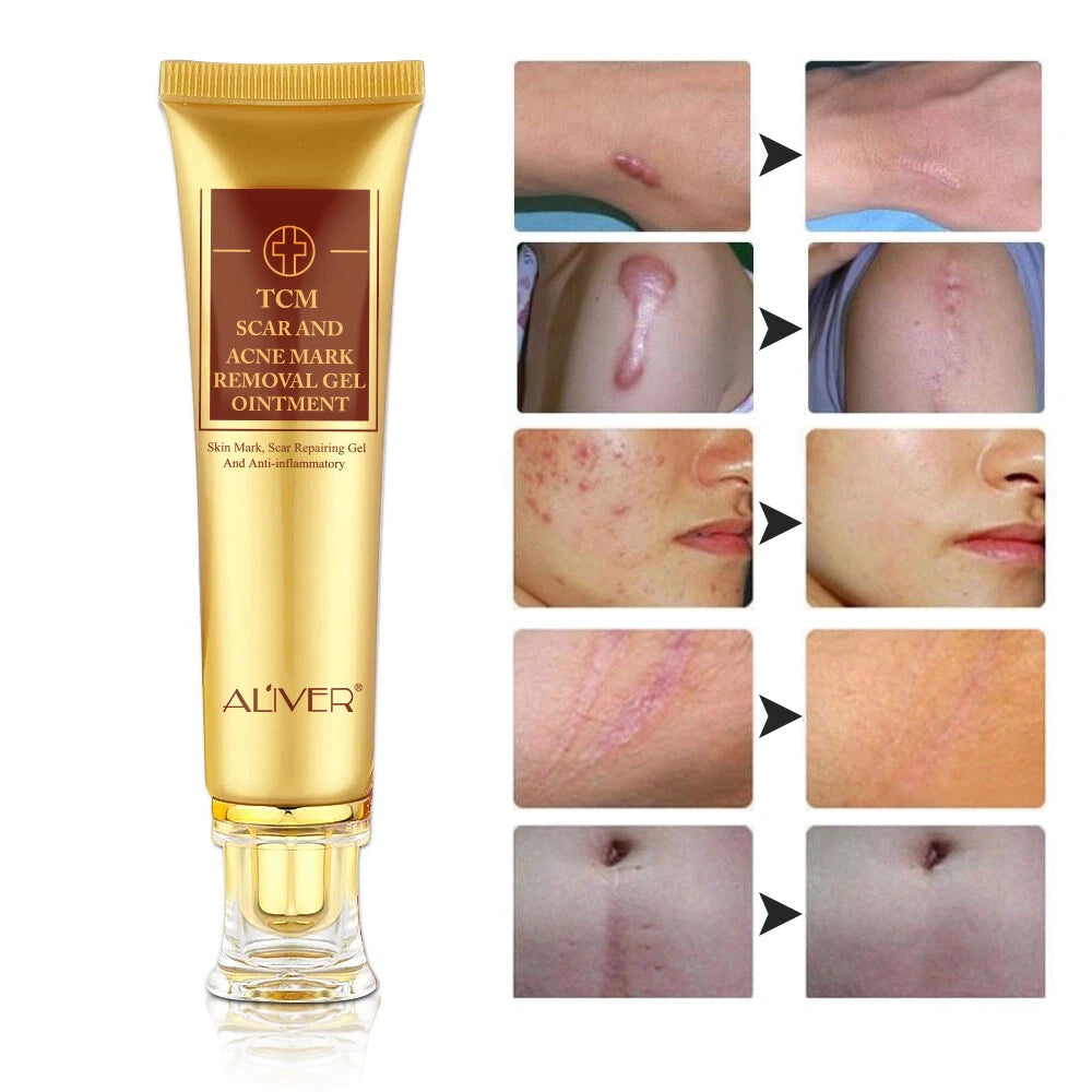 ALIVER Acne Scar Removal Cream Gel Ointment Stretch Cut Burn Spot Mark Treatment