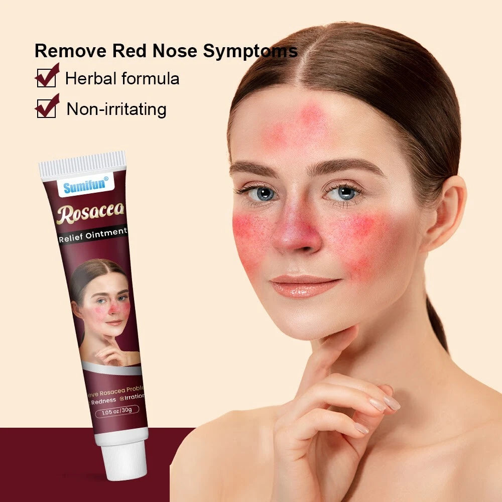 New 30g Natural Herbal Red Face Skin Care Rosacca Cream Red Skin Relief Ointment