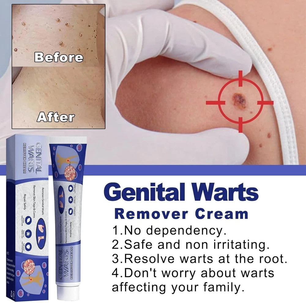Skin Tag Mole Wart Remover Removal Cream Ointment Fast Safe Natural Treatment