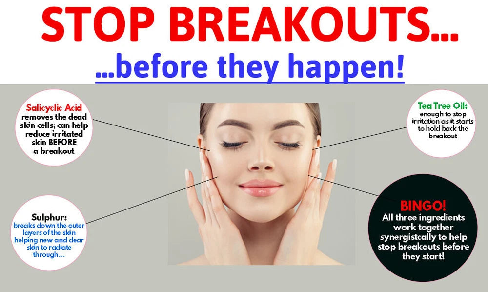 V88 Breakout Cream Salicylic Acid Spots Blackheads Blemishes Problem Skin 50 g