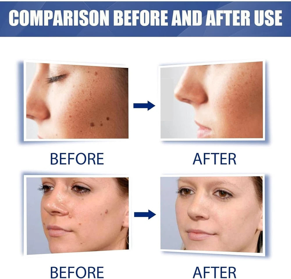 Skin Tag Mole Wart Remover Removal Cream Ointment Fast Safe Natural Treatment