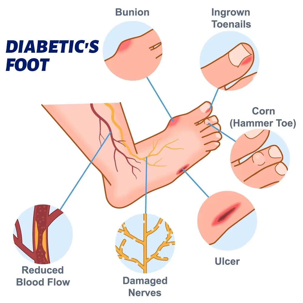 20g New Diabetic Foot Cream Ulceration Feet Erosions Anti Itchy Skin Repair