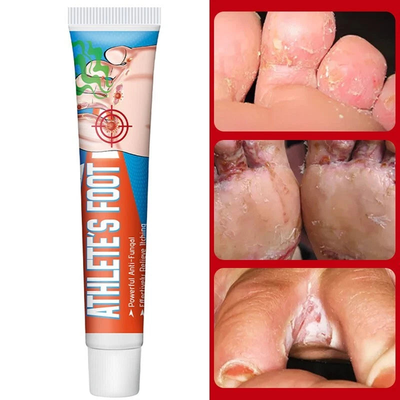 Beriberi Treat Athlete's Feet Ointment Foot Itching Anti-Fungal Peeling Tinea