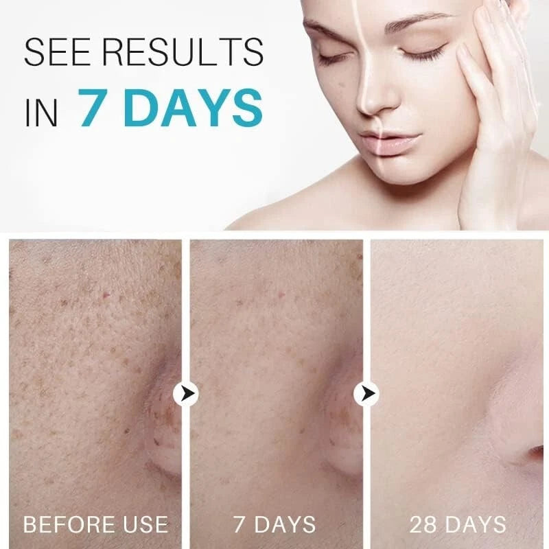 Dark Spot Remover for Face Age / Liver Spots Corrector Freckles & Skin Whitening