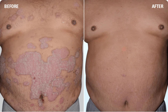 Salytar - 3% Salicylic Acid & 6% Coal Tar Ointment for Dry Skin Moisturizing 30g