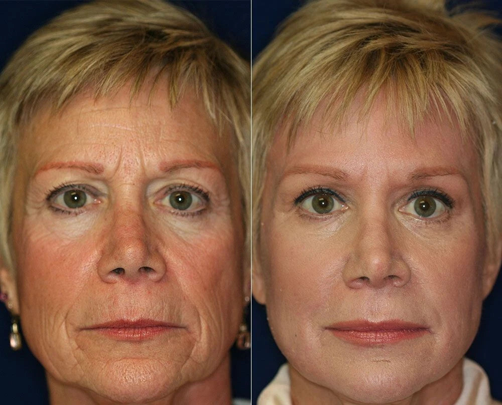 Retinol + Collagen, Hyaluronic Acid, Vitamin C AntiAging Wrinkle Serum Cream 4oz