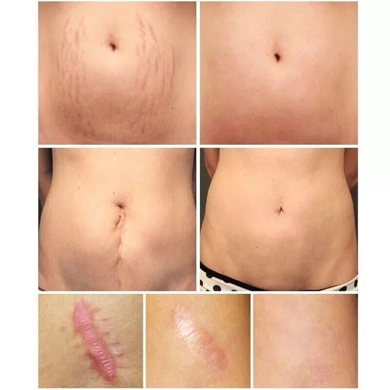 Breylee Acne Scar Removal Cream 30G Face Cream Skin Repair Skin Care Scar Acne