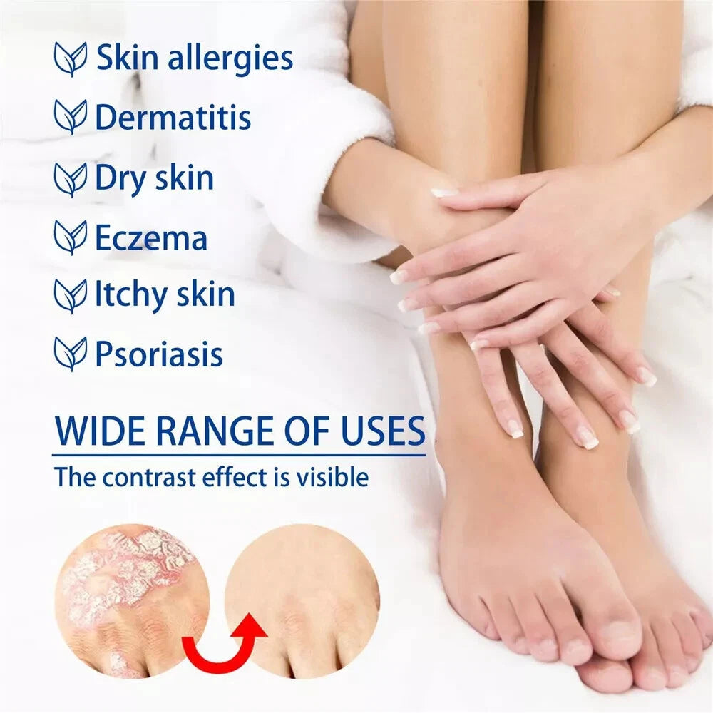Natural Psoriasis Cream for Dermatitis Eczematoid Eczema Skin Ointment Treatment