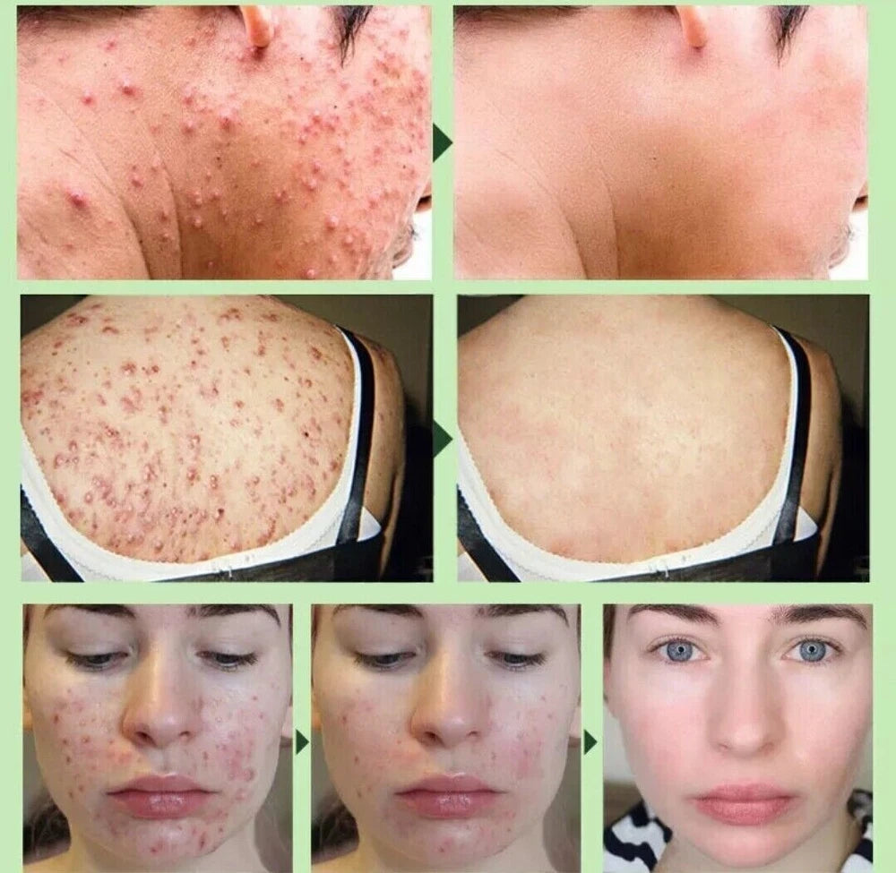 Strong Acne Scar Spots Removal Cream Cuts Burns Stretch Marks Clarifying Skin UK