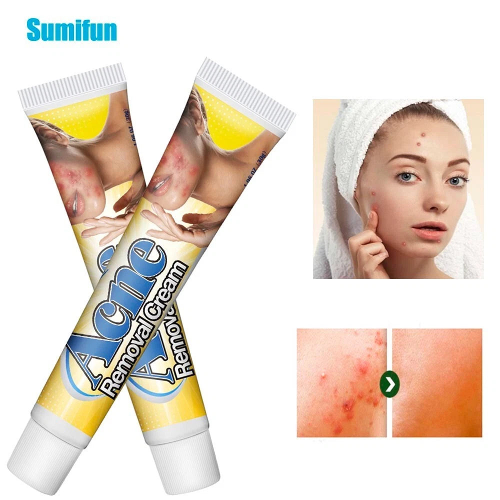 30g Acne Removal Cream Pimple Pits Pustule Deep Cleaning Face Repair Skin