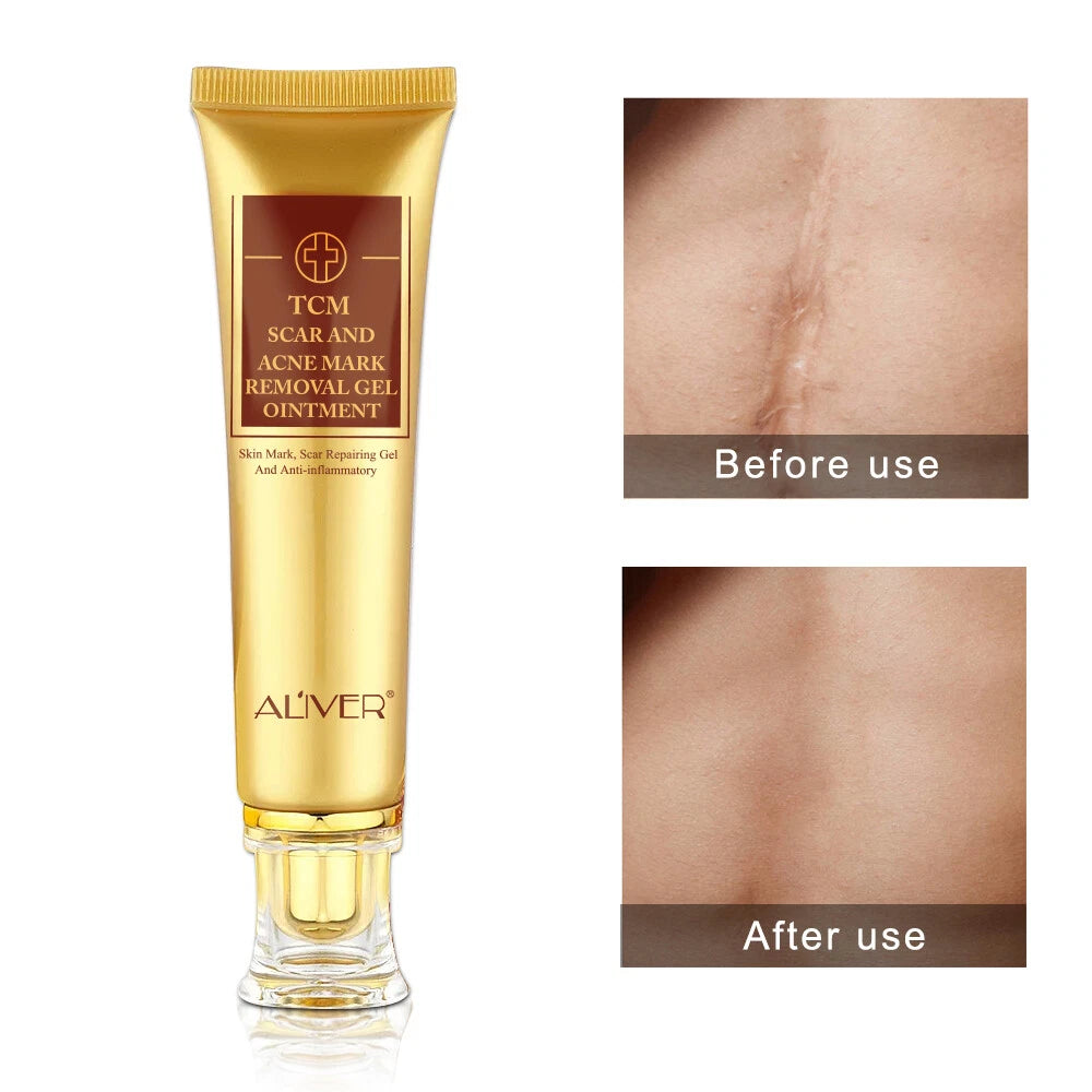 ALIVER Acne Scar Removal Cream Gel Ointment Stretch Cut Burn Spot Mark Treatment