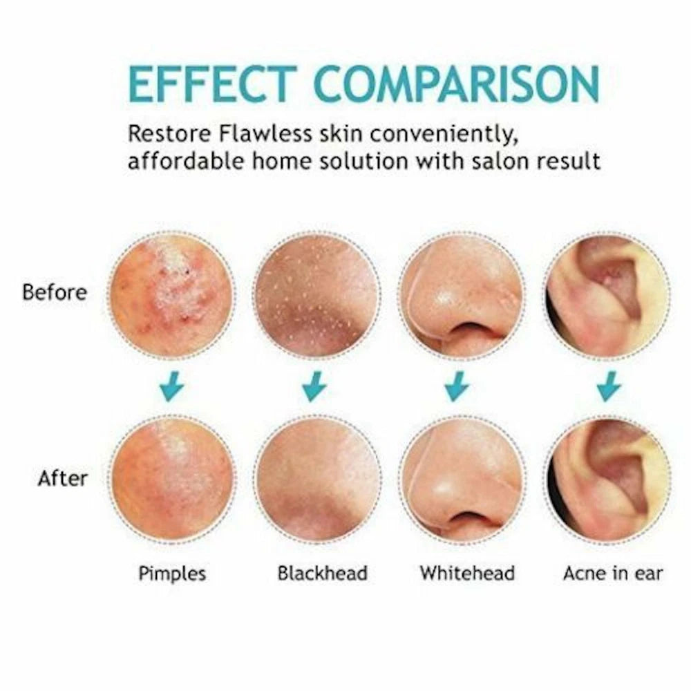 7x Blackhead Remover Tools Pimple Comedone Spot Acne Extractor Kit Popper