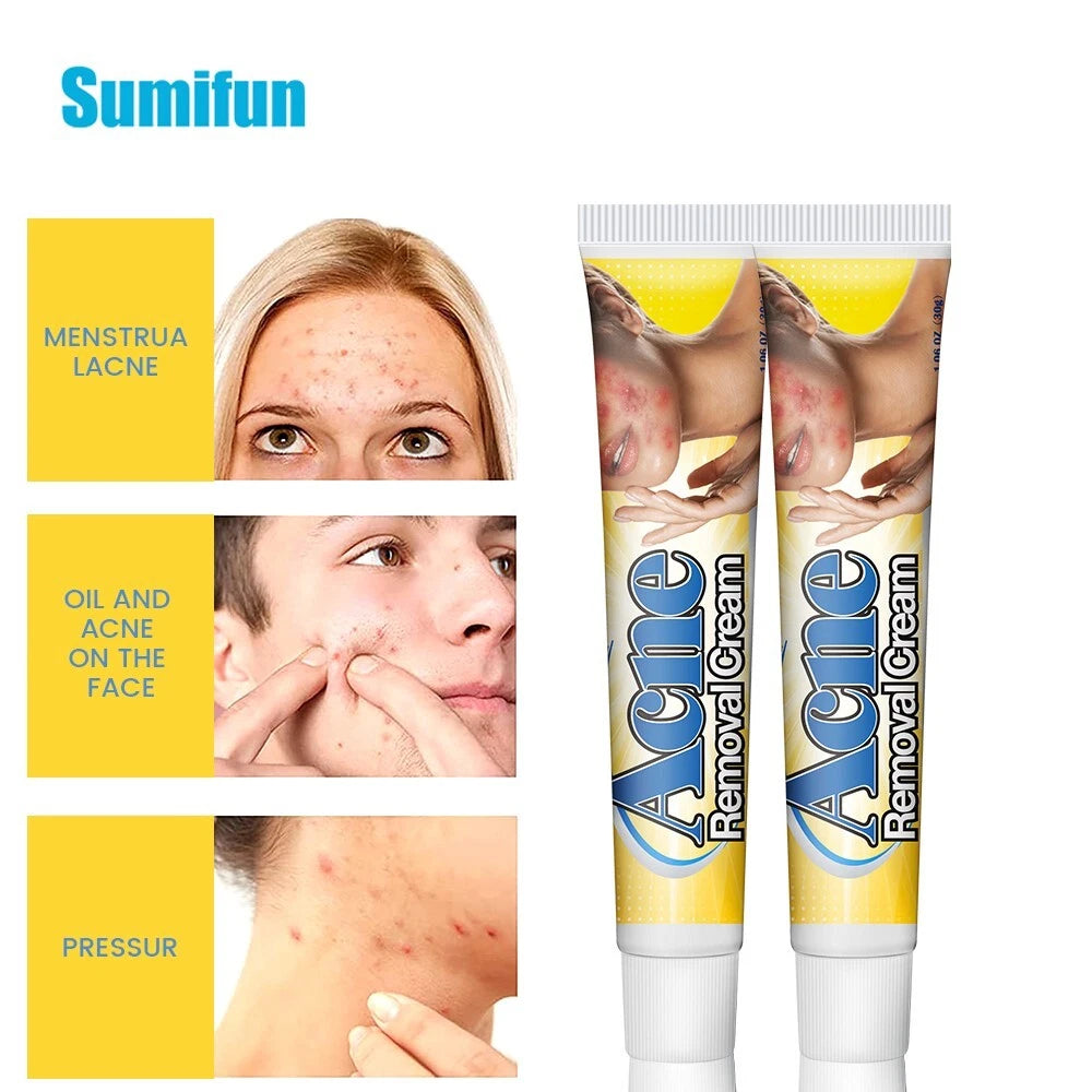 30g Acne Removal Cream Pimple Pits Pustule Deep Cleaning Face Repair Skin