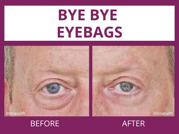 INSTANT WRINKLE Eye Tightener Cream Wrinkle Remover Serum with Argireline