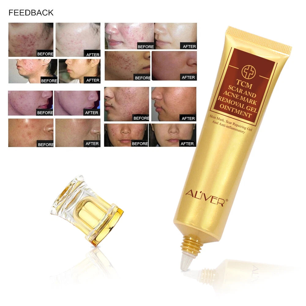 ALIVER Acne Scar Removal Cream Gel Ointment Stretch Cut Burn Spot Mark Treatment