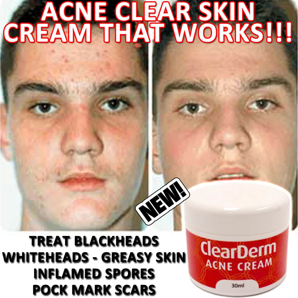 CLEARDERM ACNE CREAM LOTION CELEBRITY CLEAR SKIN SPOT PIMPLE BLACKHEAD FREE