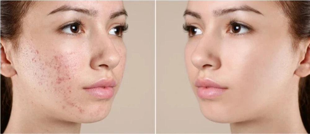 Tea Tree Cream for Acne Face & Skin Natural Antiseptic Balm 60ml 200ml UK Made