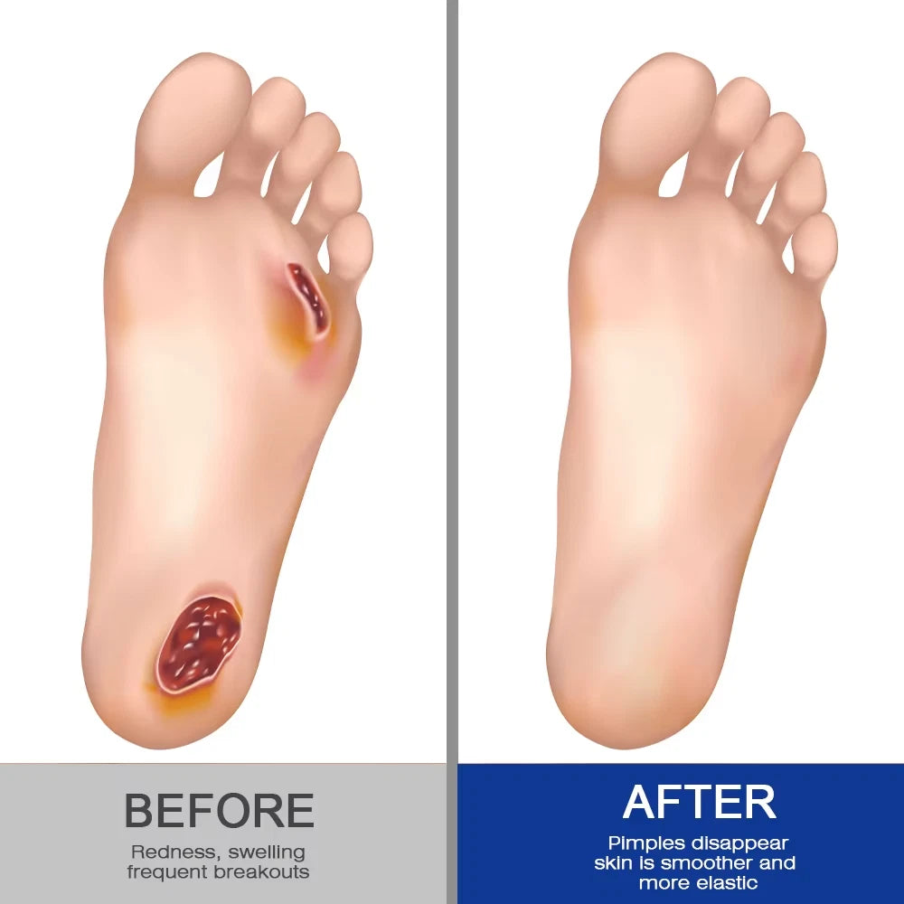 20g New Diabetic Foot Cream Ulceration Feet Erosions Anti Itchy Skin Repair