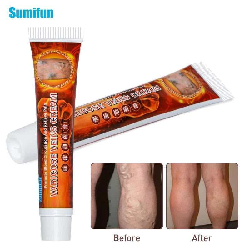 100%Original Vasculitis Blood Circulation Varicose Veins Treatment New Cream 20g
