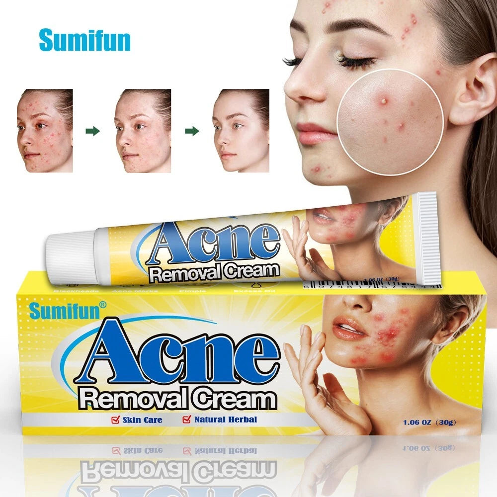 Acne Removal Cream Pimple Pits Pustule Ointment Deep Cleaning Face Repair Skin