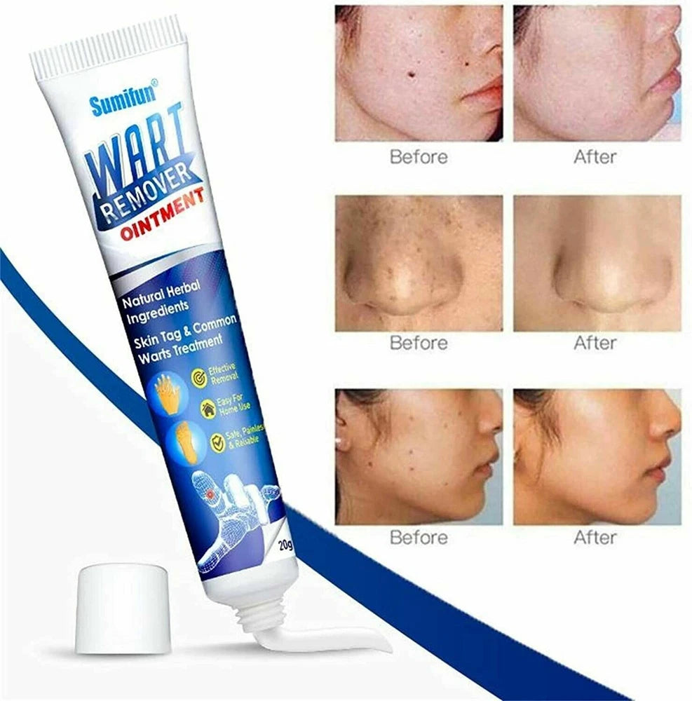Sumifun Wart Removal Body Warts Treatment Cream Foot Care Cream Skin Tag Remover
