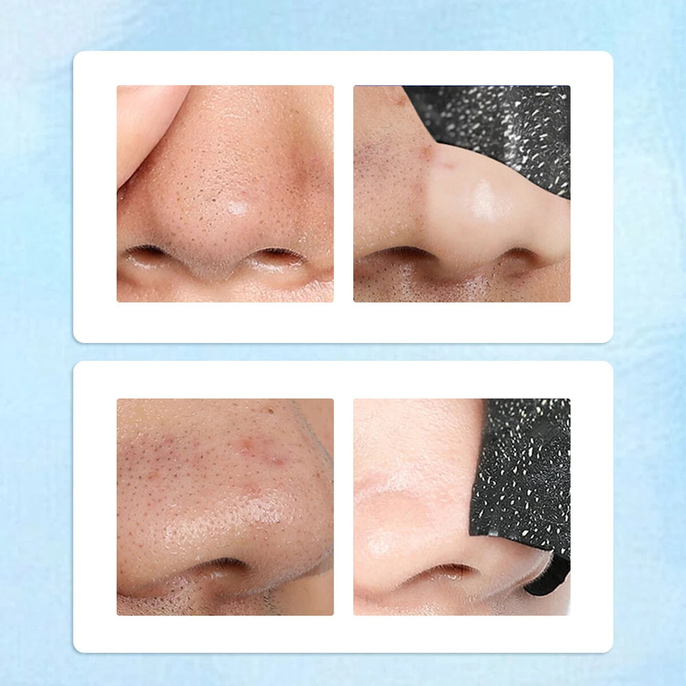 ✅10pcs Nose Pore Strips Blackhead Removal Unclog Pores Smooth Deep Cleansing NEW