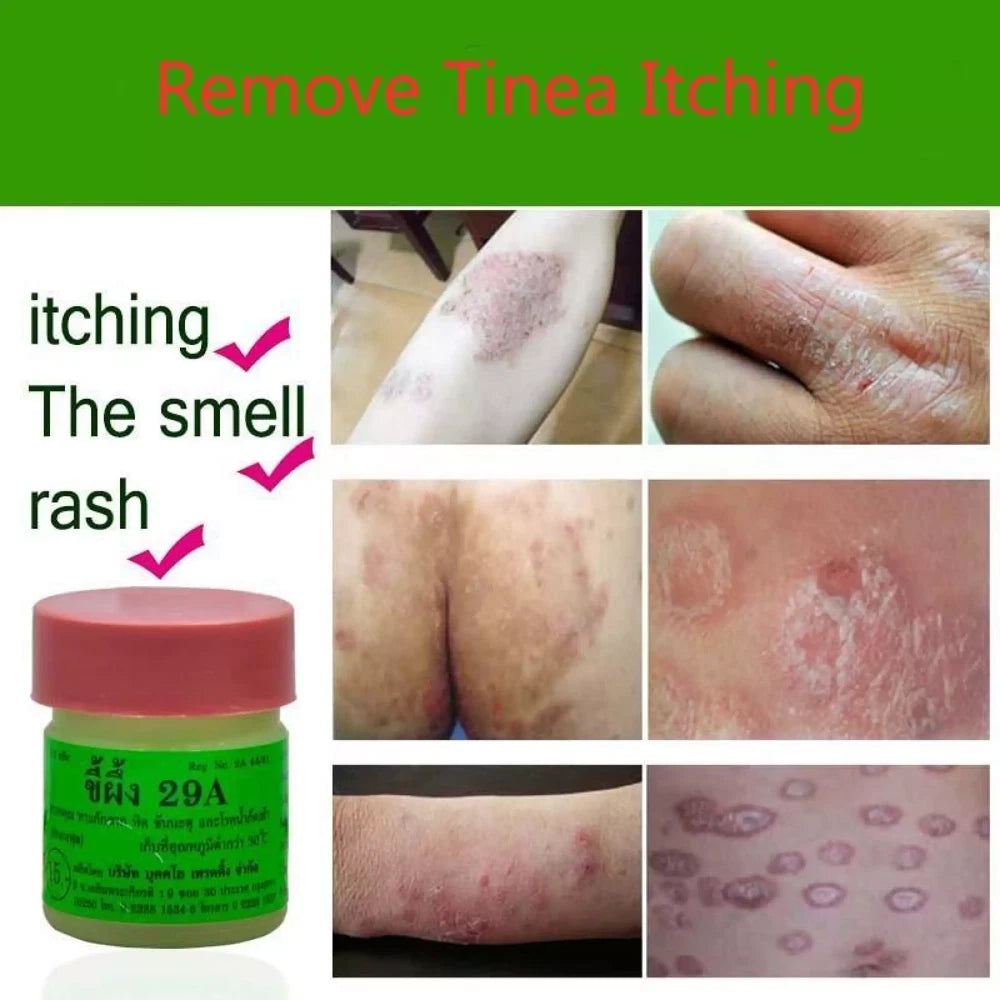 3x Effective Thailand 29A Natural Ointment Psoriasi Eczma Cream and Urticaria