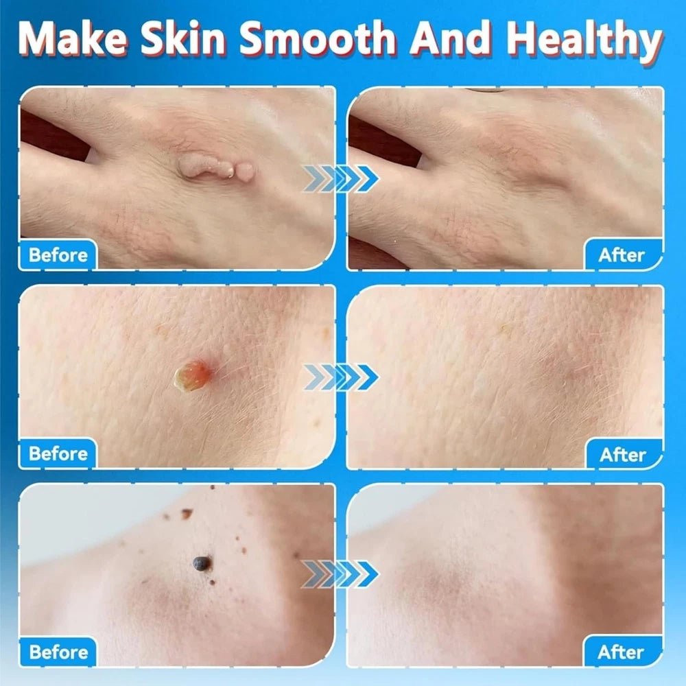 STRONG SKIN TAG REMOVER Cream NATURAL TREATMENT MOLES WARTS and TAGS