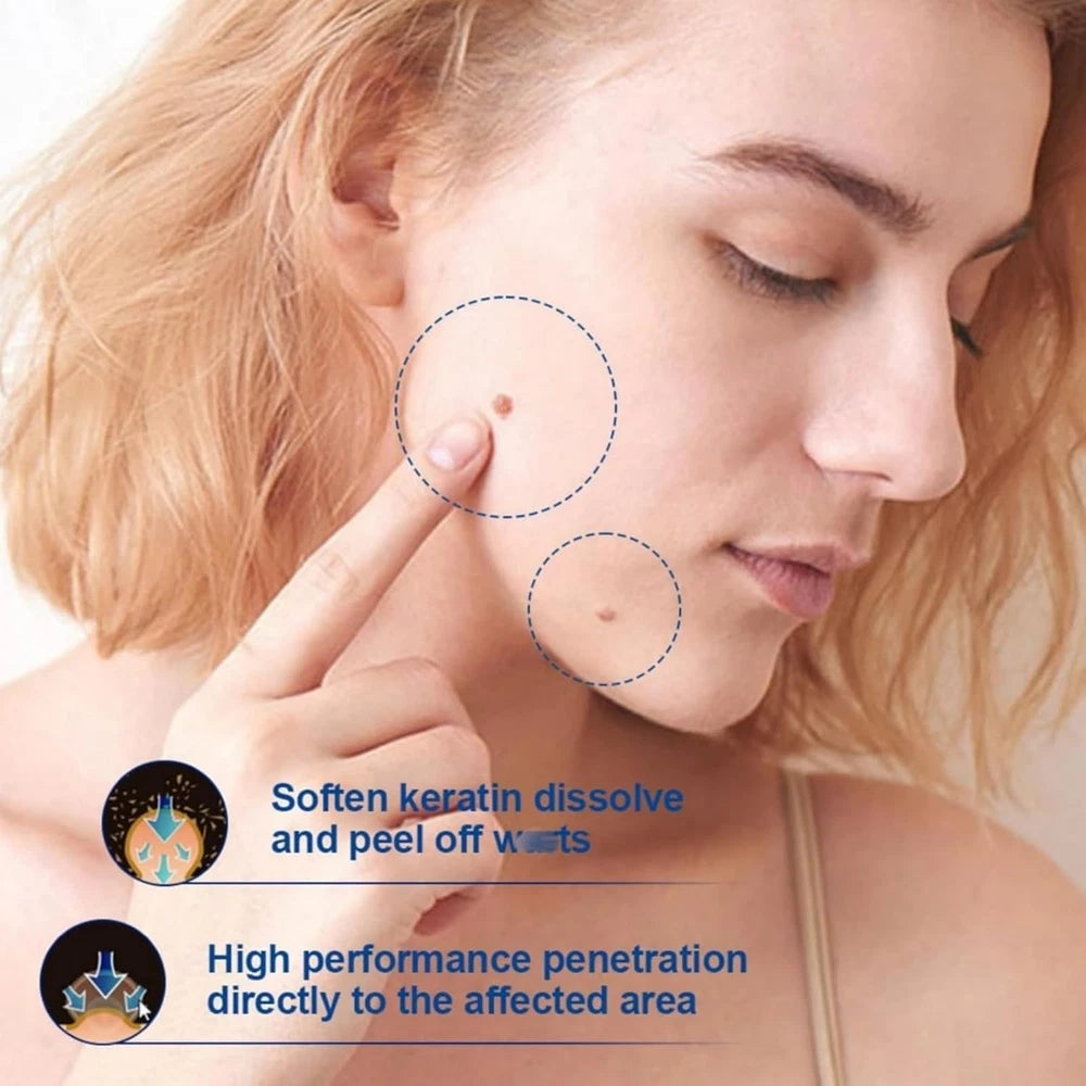 STRONG SKIN TAG REMOVER Cream NATURAL TREATMENT MOLES WARTS and TAGS