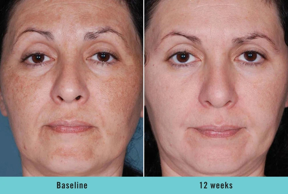 Intimate Skin Whitening Gel Lightening Body Bleach Cream, Vaginal/Anal Bleaching