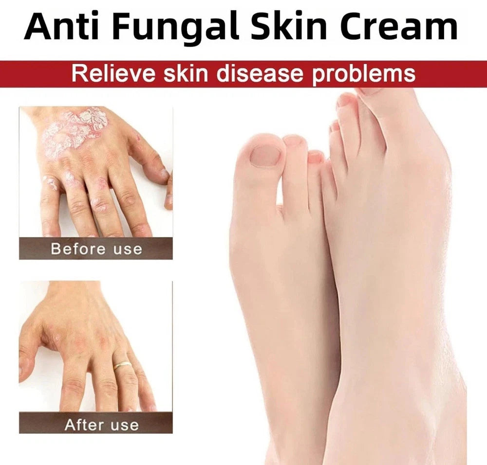 3pcs Antifungal Cream,Cream for Itchy Skin,Antifungal Cream for Skin,Itchy Skin