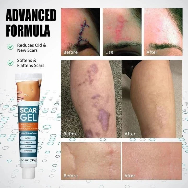 Scar Removal Cream Silicone Gel for Old & New Scars Surgery Stretch Marks