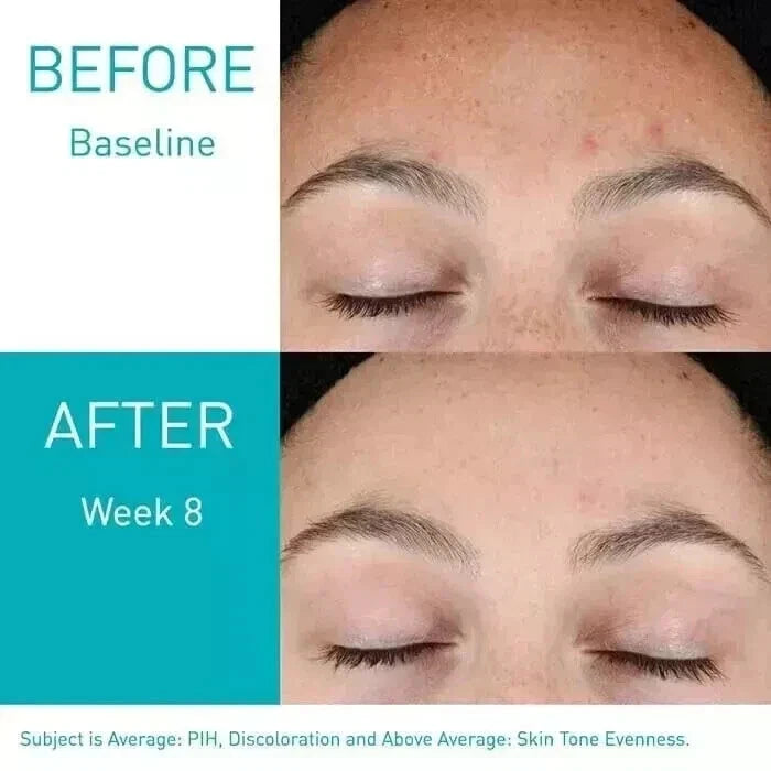 CeraVe Retinol Serum for Post-Acne Marks and Skin Texture 30ml UK