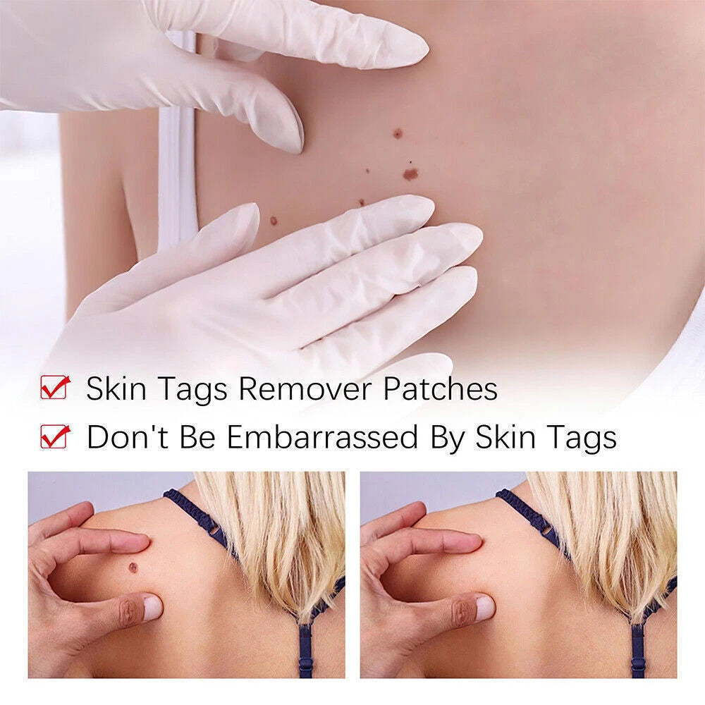 12 Hours Wart Remover Pen Skin Tag Mole Quick Remover Eliminate Foot Corn Warts