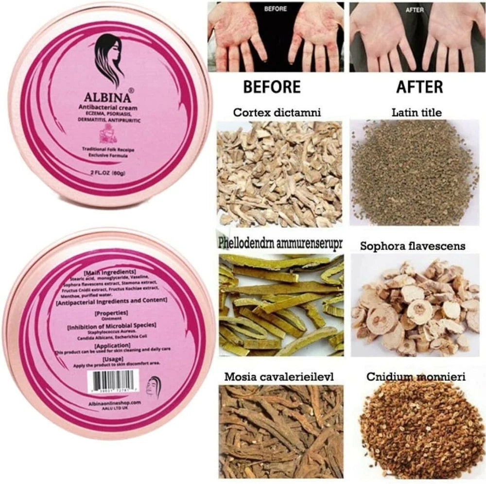 2x ALBINA Psoriasis Eczema Rosacea Dermatitis Cream, Treatment Gel 60ml - UK