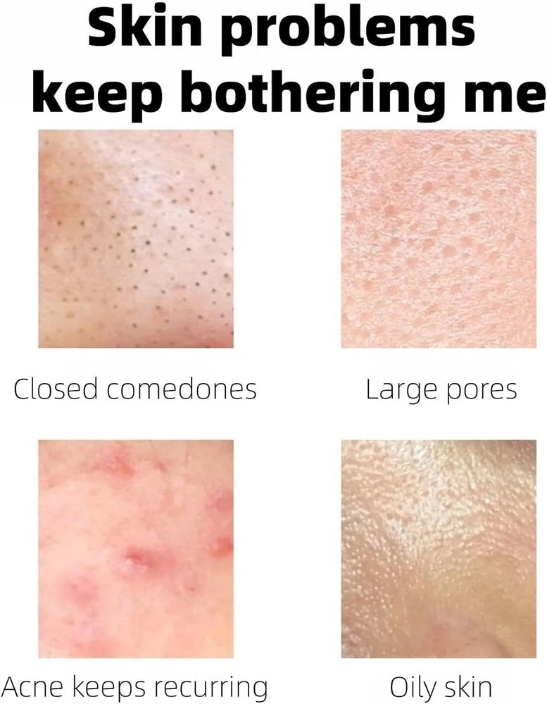 Aze-laic Acid 15% Acne Tratment Gel,15% Acid Acne Treatment Gel for Face,Azel-a